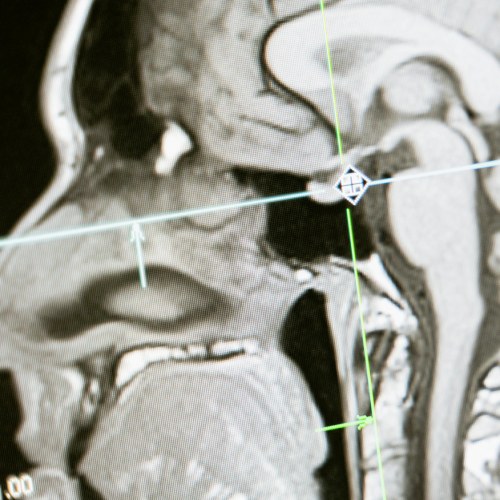 xray of a brain after a traumatic brain injury